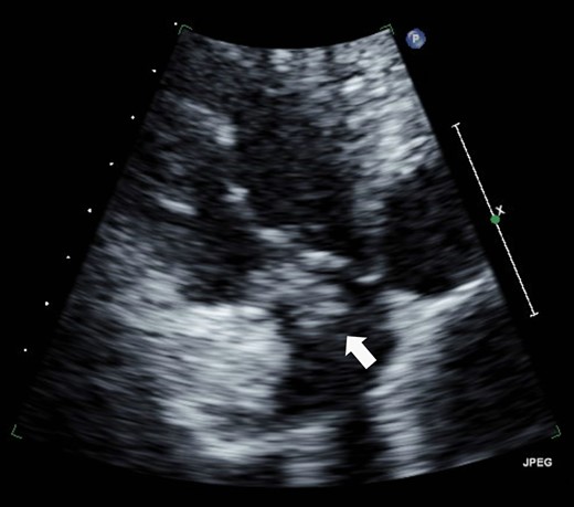 A vegetation on the tricuspid valve (arrow). Transthoracic echocardiography shows a vegetation (11 × 12 mm2) attached at the tricuspid valve.