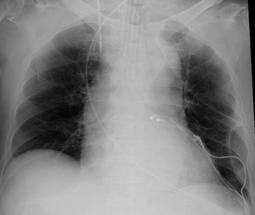 Postoperative chest X-ray.