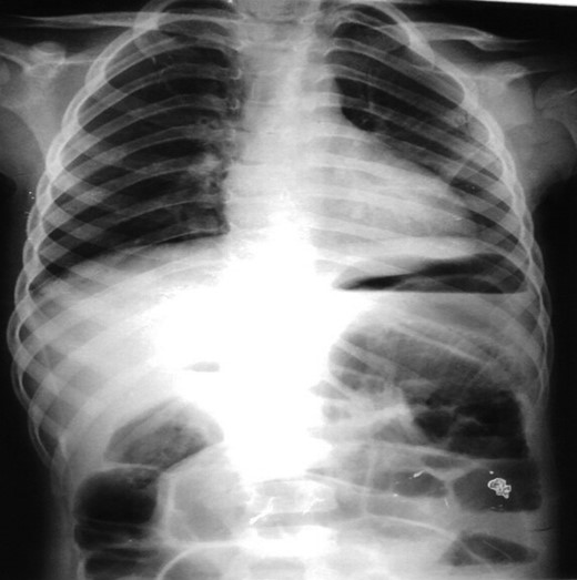 Erect AXR showing Air-Fluid levels and distended large bowel loops.