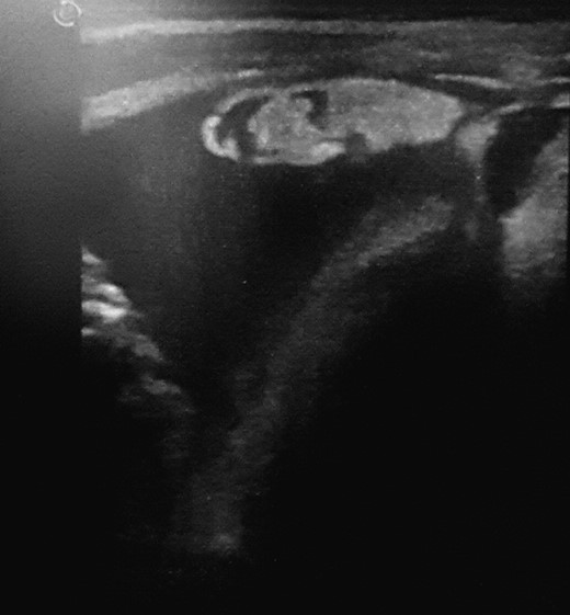 Abdominal Ultrasonography showing a 5-cm hyperechoic mass above the bladder and surrounded by intestinal loops.