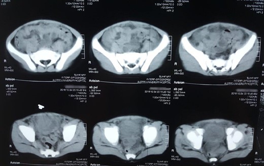 Abdominal non-contrast CT scan showed hyperdensity mass above the bladder.