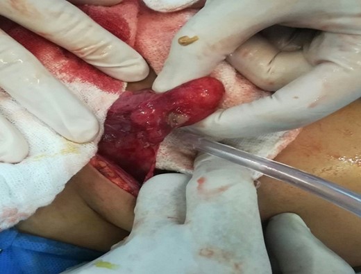 Intraoperative view of the cyst with a purulent orifice.