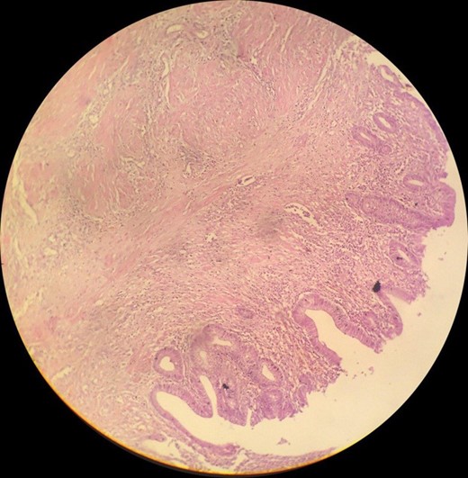 The mass cavity is lined by intestinal epithelium filled with purulent exudate infiltrating the wall that contains muscular layer.