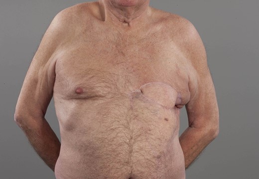 Patient in upright position. Left chest wall reconstruction with pedicled latissimus dorsi flap in combination with a V-Y fashion adipocutaneous advancement flap from his abdomen after resection of RIAS of his breast.