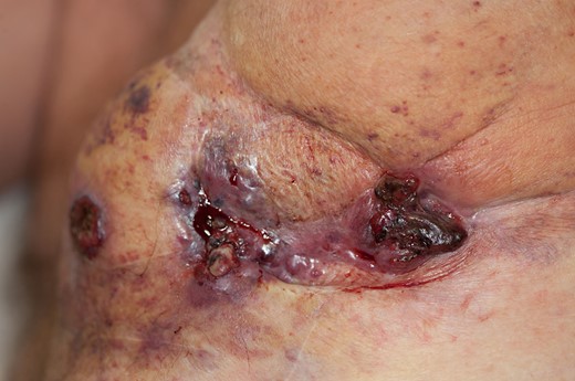 Patient in upright left lateral position. Rapidly developed wide spread disease over his left anterior and lateral chest wall not amenable to surgical treatment and electrochemotherapy. At this point chemotherapy treatment commenced with Paclitaxel.