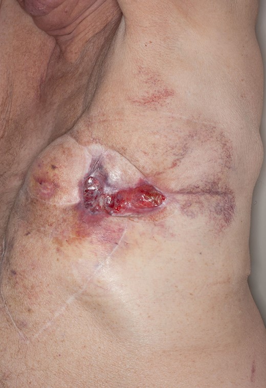 Patient in upright left lateral position. Significant control of his chest wall local disease progression with administration of full dose of Paclitaxel.