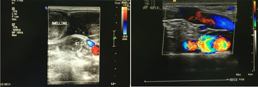 A Doppler ultrasound showing a well-defined, compressible, cystic lesion measuring 4.2 × 1.9 cm, causing an indentation of the right sternocleidomastoid muscle. The mass contained a venous pattern of flow with communication between itself and the internal jugular vein.