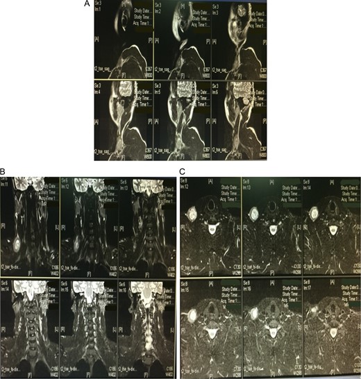 A computed tomography scan with contrast showing a dilatation in the internal jugular vein (right side) in the lower part of the neck measuring 31.6 × 42.31 mm on the cross section (A). Magnetic resonance venography further confirmed the diagnosis of an aneurysmal dilatation in the right internal jugular vein (B and C).