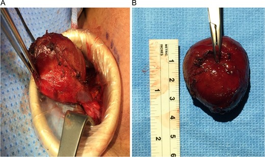 An intraoperative image showing the aneurysmal mass attached to the right internal jugular vein (A). An intraoperative image taken after excisional venotomy and whole aneurysmal wall excision were performed (B).