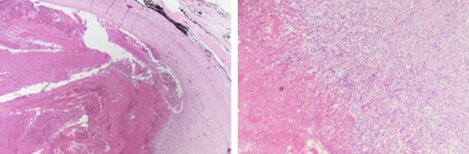 A histopathological examination of the mass showed a cystic structure containing organizing blood clots surrounded by a thick fibrous wall, suggestive of an organizing thrombosis.