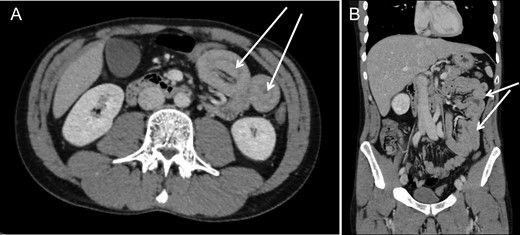 Computed tomography revealed presence of several jejuno-jejunal intussusceptions in axial (A) and coronar (B) images.