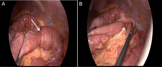 Diagnostic laparoscopy showing multiple intussusceptions (arrow) without any further pathologic findings.