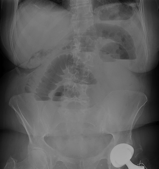 Abdominal X-rays—small bowel distension with air fluid levels.