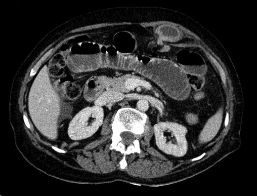 CT scan—axial view of incarcerated hernia with its sac posterior to the left rectus abdominis.