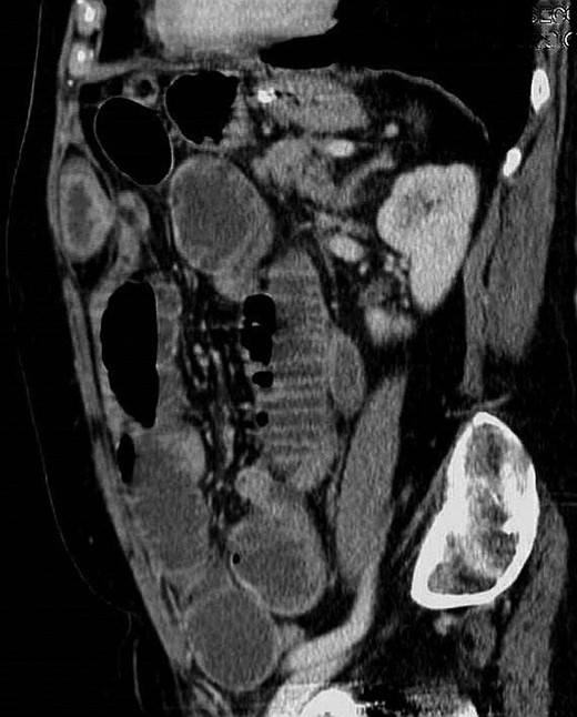 CT scan—sagittal view of posterior rectus sheath hernia.
