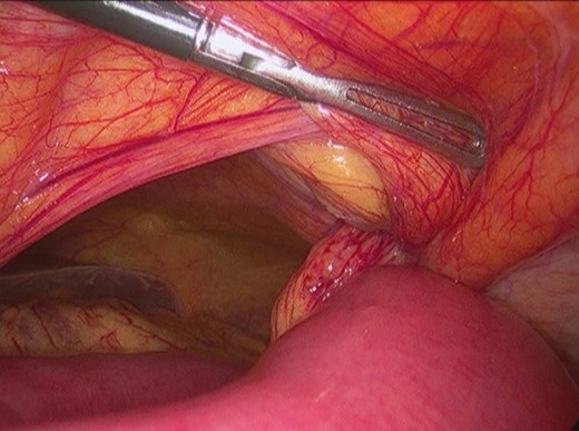 Surgery—intraoperative findings: small bowel incarcerated in the left upper abdominal wall hernia.