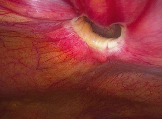 Surgery—defect in the left posterior rectus sheath.