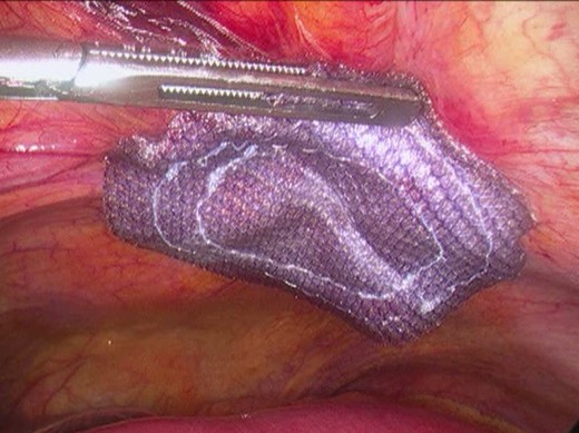 Surgery—laparoscopic mesh repair with polypropylene/PTFE mesh.