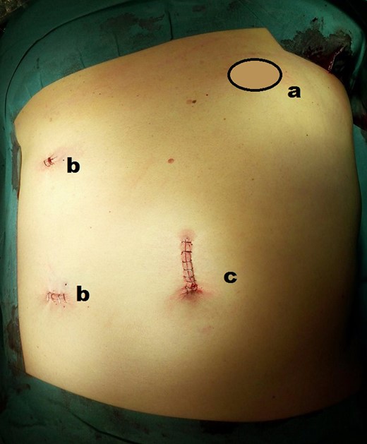 Final abdominal view—(a) hernia location; (b) local of two 5 mm ports; (c) local of 10 mm port and subsequent incision to preform small bowel resection.