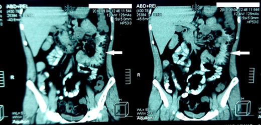 Computed tomography of the abdomen. The arrows indicate dilated proximal loop of the jejunum.
