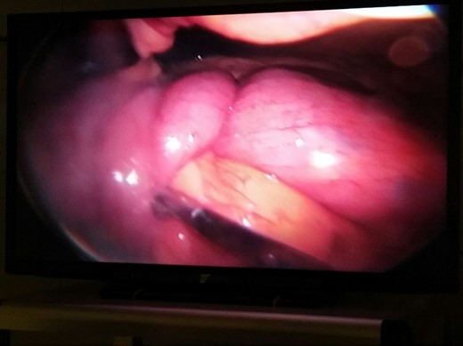 Laparoscopic view of the intussusception.