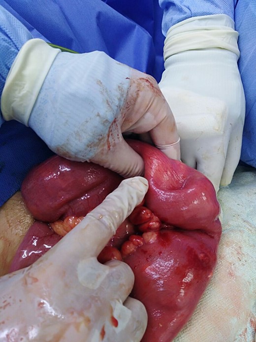 The site of intussusception after reduction.