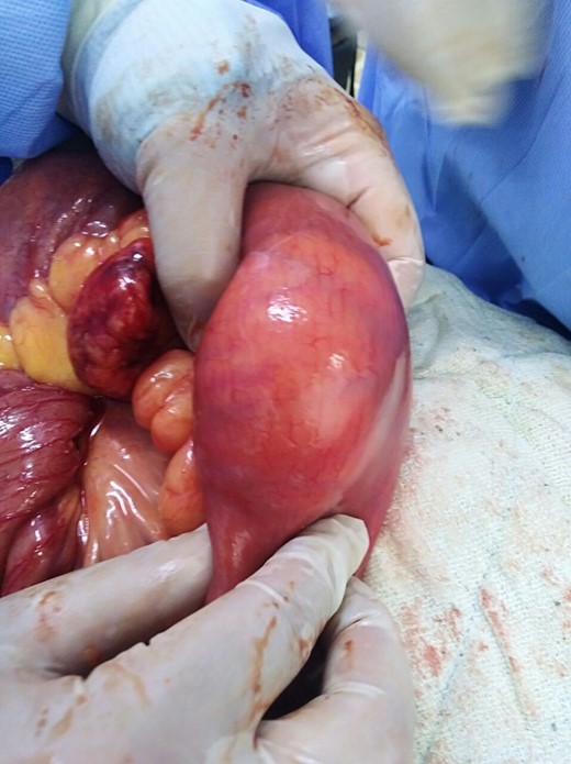 The leading point lipoma that caused the intussusception.
