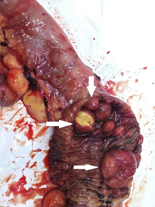 The resected segment of the jejunum. The arrows point to multiple lipomas.