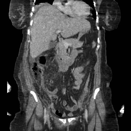 Coronal section CT scan image of the patient’s abdomen.