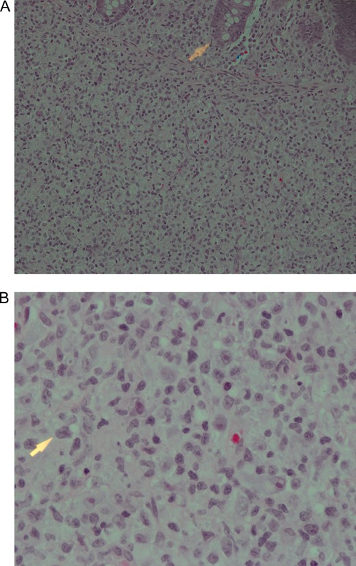 (A) Submucosa nodule consisting of mixed inflammatory cells including numerous histiocytes with many B and T lymphocytes. The arrowhead is pointing towards the edge of a mucosal crypt. Haematoxylin and eosin stain ×200. (B) High power view of the nodule described in (A). Note the presence of some pleomorphic cells showing prominent nucleoli. Haematoxylin and eosin stain ×600.