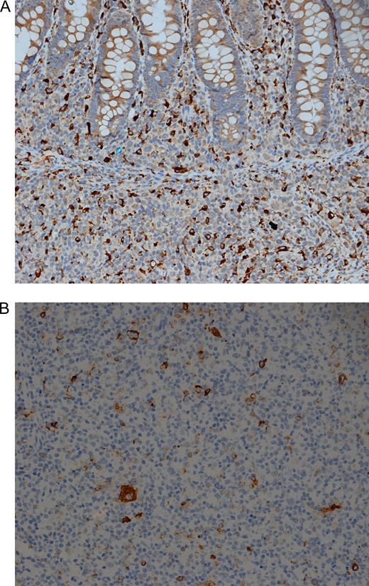 (A) Immunohistochemical stain for the histiocytic marker CD68 is positive in a large number of histiocytes IHC for CD68 ×200. (B) Immunohistochemical stain for Epstein Barr virus. Note the strong positive membranous / cytoplasmic staining in several cells. IHC EBV ×200.