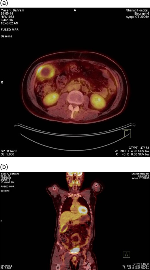 FDG PET-CT with (a) trans-axial and (b) coronal views. PET-CT scan performed to evaluate a patient with colon cancer interfacing mild rise in blood CEA level. One hour after the intravenous administration of 11 mCi of 18 F-FDG, PET-CT images were obtained. A strikingly enlarged gallbladder shows intense radiotracer uptake in the gallbladder wall with a central photopenic area representing a rim like pattern. Metabolically active wall proposes the possibility of cholecystitis (acute/chronic). The patient underwent laparoscopic cholecystectomy. The histopathologic evaluation confirmed imaging findings as acute on chronic cholecystitis. Two months following surgical intervention, the CEA level declined to the normal range.