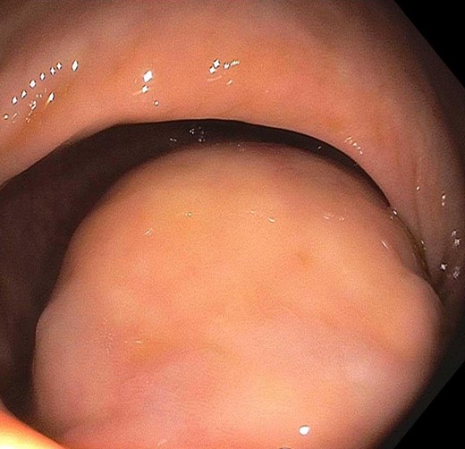 Endoscopy visualizing rectal polyp.