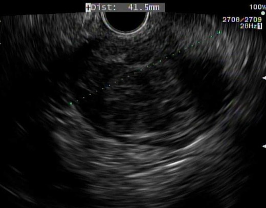 EUS demonstrating 4.1 cm submucosal mass.