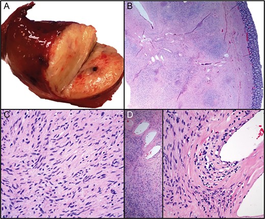 The lesion was grossly a tan-pink, soft mass with golden to tan firm, nodular cut-surfaces ( A). Histopathological examination revealed a variably cellular, well-circumscribed submucosal lesion (B) with bland spindle cells ( C), lymphocytes, plasma cells and eosinophils (D). No pleomorphism, mitoses or necroses were identified. Areas with thick-walled vessels were also seen (D).