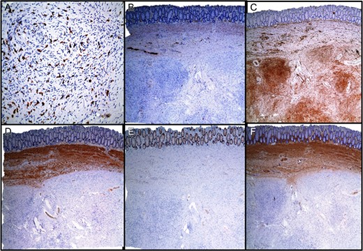 Immunohistochemical staining. (A) CD117, (B) S100, (C) CD34, (D) CALPONIN, (E) EMA, (F) SMA.