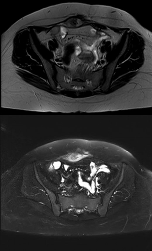 MRI images demonstrating the recurrent abdominal wall desmoid tumor located in the right lower abdomen, which is heterogeneously hypertense on T2 and hypointense on T1.