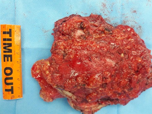 An image of the surgical specimen after ultrasound aided resection of the desmoid tumor with 2 cm margin.