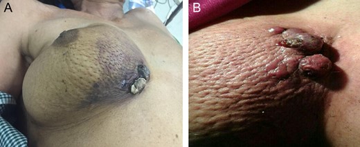 Splotchy purplish nodules in right breast in lower medial quadrant (A) With surrounding discoloration (B) Close up view.