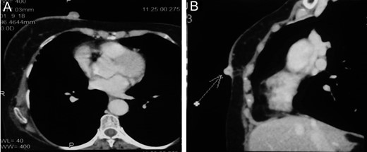 CECT showing enhancing cutaneous nodules in right breast with minimal fat stranding without evidence of deeper tissue penetration (A)Axial section (B)Sagittal section.