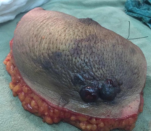 Resected total mastectomy specimen with the nodules.