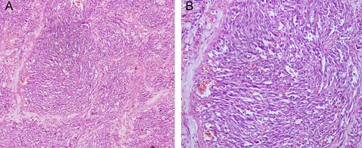 Histopathology (Hematoxylin & Eosin stain) showing interanastomosing vascular channels with cytologic atypia and infrequent mitoses suggestive of intermediate grade angiosarcoma (A) 100x magnification (B) 200x magnification.