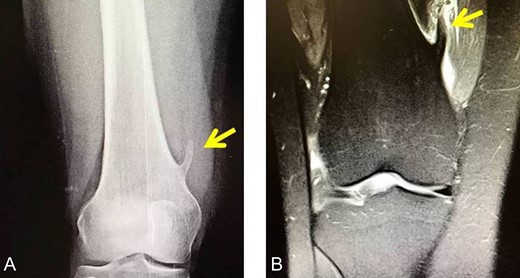 (A) The X-ray depicting the exostosis (yellow arrow), (B) MRI depiction of the exostosis.