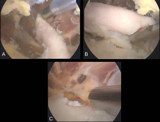 (A) Arthroscopical view of the extra-articular knee osteochondroma, (B) Arthroscopic excision of the osteochondroma, C. Abrasion of the remaining bony surface.