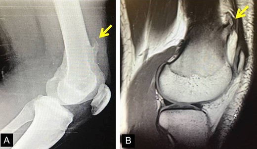 (A) X-ray of the exostosis in the second patient, (B) MRI depicts the lesion.