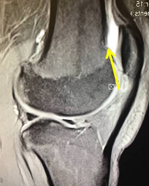 MRI confirms no recurrence (long yellow arrow).