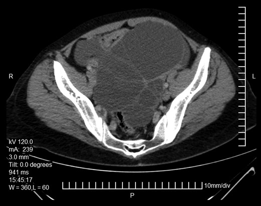Abdominopelvic CT. Bilateral ovarian masses with characteristic diaphragms.