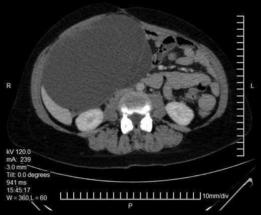 Abdominopelvic CT. Enlarged ovarian mass.