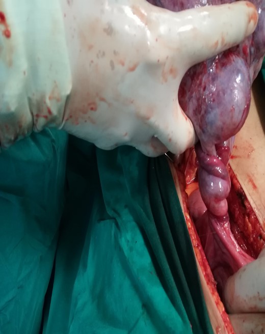 Intraoperative findings. Nekrotized ovarian torsion.