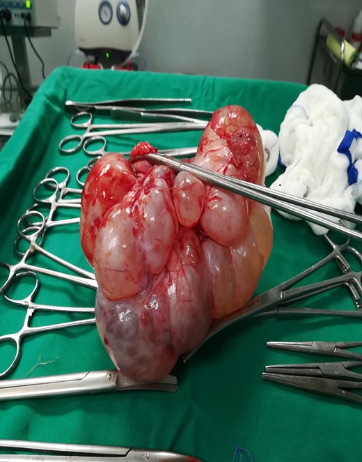 Intraoperative findings. Multilobular borderline ovarian mass.